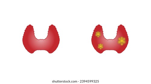 Healthy Thyroid gland and unhealthy thyroid with Inflammation and lump, thyroid cancer. Vector illustration isolated on white background.