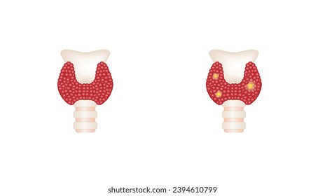 Healthy Thyroid gland and unhealthy thyroid with Inflammation and lump, thyroid cancer. Vector illustration isolated on white background.