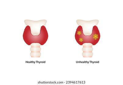 Healthy Thyroid gland and unhealthy thyroid with Inflammation and lump, thyroid cancer. Vector illustration isolated on white background.