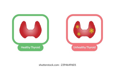 Healthy Thyroid gland and unhealthy thyroid with Inflammation and lump, thyroid cancer. Vector illustration isolated on white background.