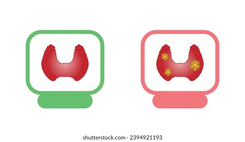 Healthy Thyroid gland and unhealthy thyroid with Inflammation and lump, thyroid cancer. Vector illustration isolated on white background.