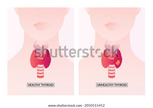 Healthy Thyroid Gland Unhealthy Thyroid Inflammation Stock Vector 