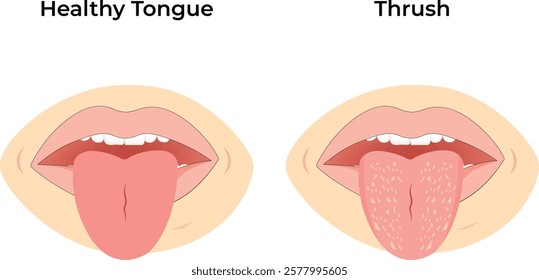 Healthy Tongue vs Thrush Design Vector Illustration