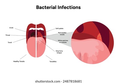 Healthy tonsils and Bacterial infections tonsillitis, open mouth with zoom bacterias