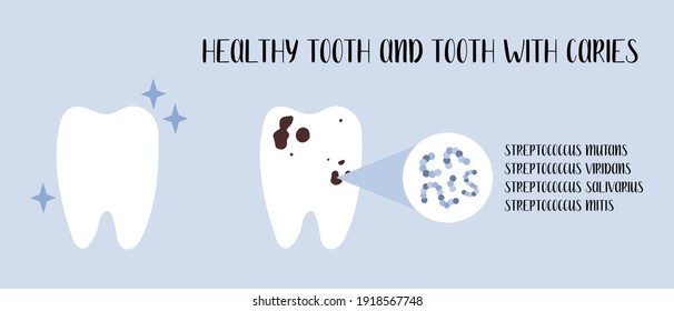 Healthy tooth and tooth with caries. Plaque bacteria: Streptococcus mutans, Streptococcus viridans. Oral care. Dental cavity, teeth hygiene. Vector flat cartoon illustration