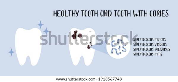 Healthy tooth and tooth\
with caries. Plaque bacteria: Streptococcus mutans, Streptococcus\
viridans. Oral care. Dental cavity, teeth hygiene. Vector flat\
cartoon illustration
