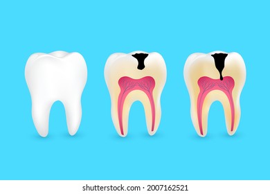 Healthy tooth and tooth caries. Superficial caries; deep caries; enamel and dentin decay; periodontitis.