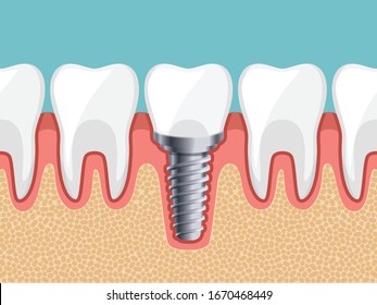 Healthy tooth, Dental Implant, Human teeth, Vector illustration. 