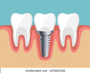 Healthy tooth, Dental Implant, Human teeth, Vector illustration. 