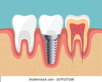 Healthy tooth, Dental Implant, Tooth inside, Human teeth, Vector illustration. 