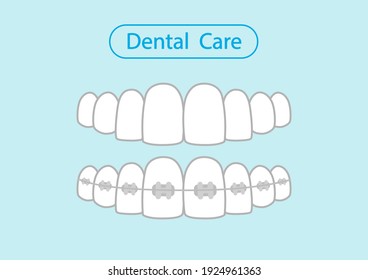 Healthy tooth and orthodontic model on blue background. Tooth Icon, healthy tooth, Vector illustration.