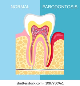 healthy tooth and tooth with periodontal disease. anatomy of human organs. Tooth periodontal disease. Vector image tooth Periodontitis disease