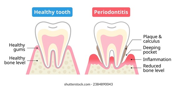 Healthy tooth and periodontal disease. Dental and oral health care concept.