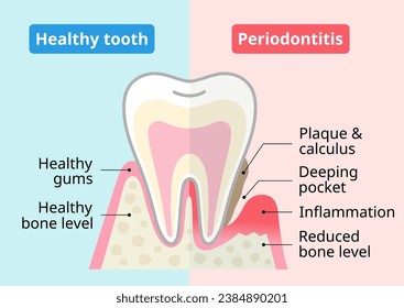 Healthy tooth and periodontal disease. Dental and oral health care concept.