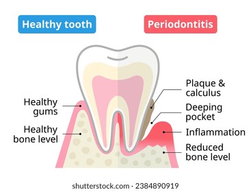 Healthy tooth and periodontal disease. Dental and oral health care concept.