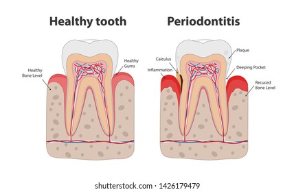 Healthy tooth and unhealthy tooth with periodontitis with gum inflammation infographic elements isolated on white background. Medical dental poster illustration in flat design.