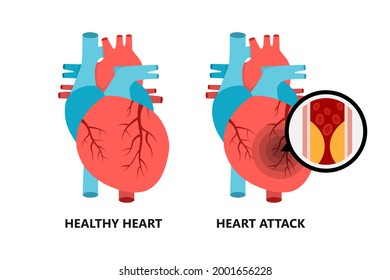 Healthy Unhealthy Heart Heart Atherosclerotic Plaque Stock Vector ...