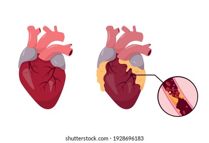 Healthy And Unhealthy Human Heart. Ischemic Disease. Blocked Coronary Artery With Atherosclerosis. Vector Illustration On White Background.