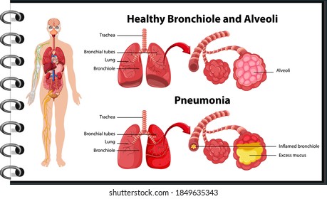 Healthy and unhealthy of human lungs illustration