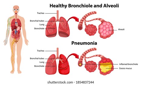 Healthy and unhealthy of human lungs illustration