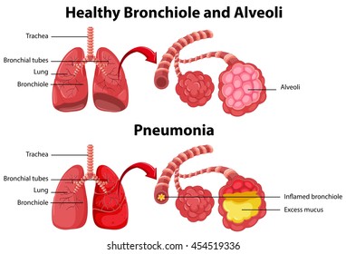 Healthy Unhealthy Human Lungs Illustration Stock Vector (Royalty Free ...