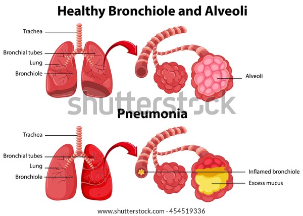 Healthy Unhealthy Human Lungs Illustration Stock Vector (Royalty Free ...