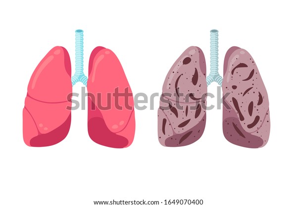 Healthy Unhealthy Lungs Compare Concept Human Stock Vector (Royalty ...