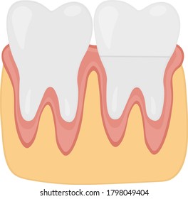 Healthy and unhealthy teeth prosthetics crown installation dentistry vector illustration.
