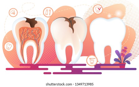 Healthy and Unhealthy Teeth Stand in Raw. Tooth Decay Cross Section with all Parts and Caries Hole. Dentistry Icons with Implantat, Toothpaste and Brush on White Background. Flat Vector Illustration