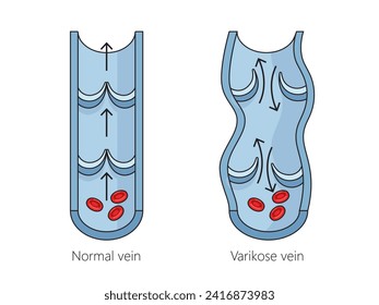 Strukturdiagramm der gesunden Venen und der Krampfader handgezeichnet schematische Vektorgrafik. Illustration in der Medizin