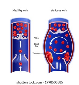 Healthy vein, and varicose vein. Cross section of normal blood vessel and thrombus in blood flow. vector illustration