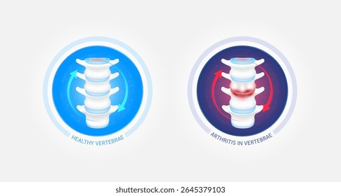 Ossos de vértebras saudáveis e artrite ou osteoporose com setas vermelhas azuis giram ao redor. A cartilagem da articulação espinhal torna-se gasta. Imagens comparativas de ossos normais e inflamados. Vetor EPS10.