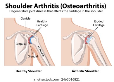 Diagrama de articulación de hombro sana vs. artrítica