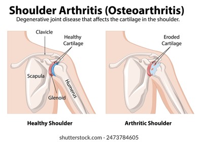 Healthy vs. arthritic shoulder joint diagram