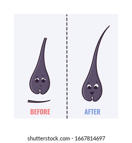 Healthy vs damaged hair follicle cartoon characters in good and bad condition. Removal, treatment and transplantation concept. Trichology medical vector illustration.