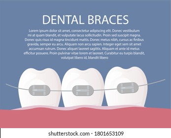 healthy white and straight teeth with braces. Dental care service - Orthodontic treatment and straightening of teeth. Flat vector illustration