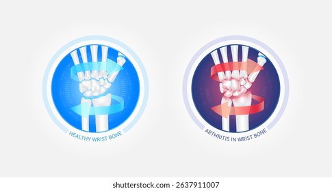 Healthy wrist bone and arthritis or osteoporosis with red blue arrows spin around. Joint hand cartilage becomes worn. Comparative images of normal and inflammation bones. Vector EPS10.