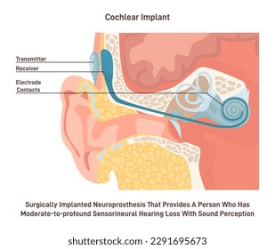 Hearing aid or cochlear implant. Surgically implanted neuroprosthesis to a deaf person. Hearing loss assistance with electrical stimulation of the auditory nerve. Flat vector illustration