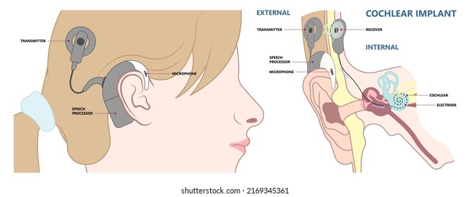 Hearing Aid Ear Child Deaf Signal Baby Inner Middle Bone Loss Outer Canal Birth Meniere's Cochlea Brain Implantation Test Exam