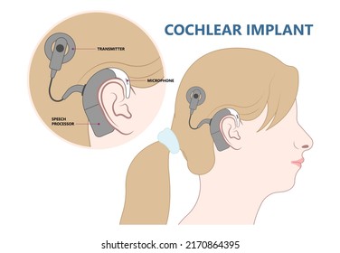 Hearing Aid Ear Child Deaf Signal Baby Inner Middle Bone Loss Outer Canal Birth Meniere's Cochlea Brain Implantation Test Exam