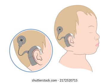 Hearing Aid Ear Child Deaf Signal Baby Inner Middle Bone Loss Outer Canal Birth Meniere's Cochlea Brain Implantation Test Exam