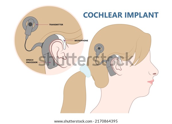 hearing aid ear child deaf signal baby inner middle\
bone loss outer canal birth meniere\'s cochlea brain implantation\
test exam