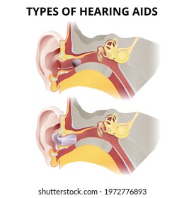 Hearing aid, location in the ear, types of hearing aids, sectional view of the inner ear