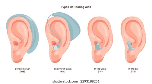 Hearing aids types set. Neuroprosthesis to a deaf person. Hearing loss assistance with electrical stimulation of the auditory nerve. Flat vector illustration