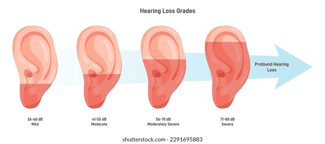 Hearing loss stages. Medical diagnosis of hearing system disease. Decibel dB hearing level. Flat vector illustration