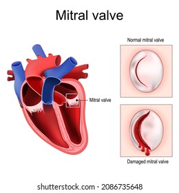 Heart anatomy. Close-up of Normal Mitral valve and Damaged mitral valve. Cross section of human heart. detailed diagram. Vector poster