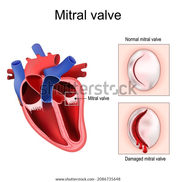 Heart anatomy. Close-up of Normal Mitral valve and\
Damaged mitral valve. Cross section of human heart. detailed\
diagram. Vector poster