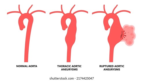 Heart Aorta Attack Aortic Arch Bulge Open Dilated Chest Renal Vein Clots Stent Stroke Marfan Root Left Graft Hernia Vessel Pain High Blood Kidney Damage Turner