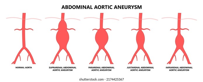 Heart Aorta Attack Aortic Arch Bulge Open Dilated Chest Renal Vein Clots Stent Stroke Marfan Root Left Graft Hernia Vessel Pain High Blood Kidney Damage Turner