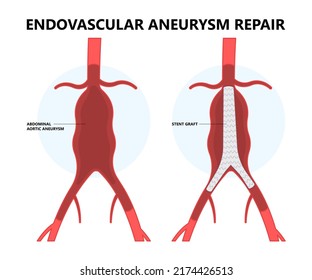 Heart Aorta Attack Aortic Arch Bulge Open Dilated Chest Renal Vein Clots Stent Stroke Marfan Root Left Graft Hernia Vessel Pain High Blood Kidney Damage Turner